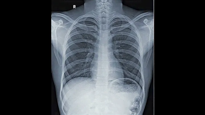Normal X-Ray 🆚 Abnormal Consolidation X-Ray #aiims #biology