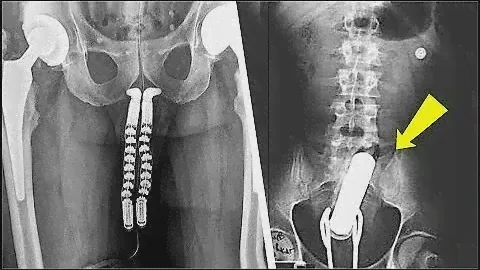 15 Strangest Things Discovered By X-Rays